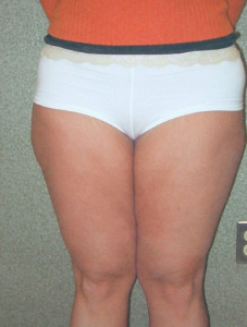 Liposuction Patient 53168 Before Photo # 1