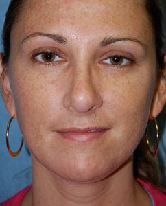 Rhinoplasty Patient 70122 After Photo # 2