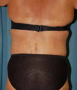 Body Lift Patient 56396 After Photo # 8