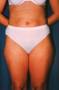 Liposuction Patient 71514 Before Photo # 1