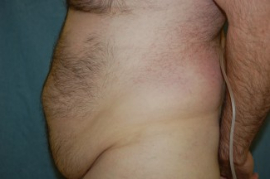 Tummy Tuck Patient 95680 Before Photo # 5