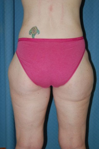 Body Lift Patient 69575 After Photo # 4