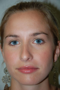 Rhinoplasty Patient 65711 After Photo # 2