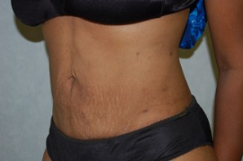 Liposuction Patient 62658 After Photo # 4