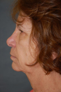 Eye Lift - Blepharoplasty Patient 52177 Before Photo # 5