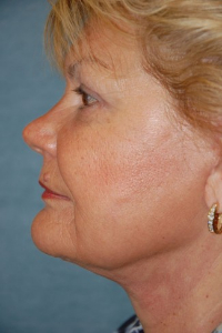 Face Lift and Neck Lift Patient 74597 After Photo # 6