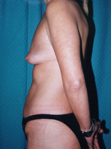 Mini Tummy Tuck Patient 86611 Before Photo # 3