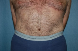 Tummy Tuck Patient 95680 After Photo # 2