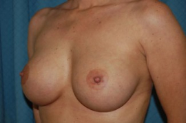 Breast Augmentation Patient 89092 After Photo # 4