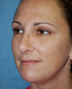 Rhinoplasty Patient 70122 After Photo # 4