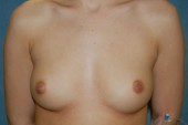 Breast Augmentation Patient 19168 Before Photo # 1