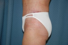 Body Lift Patient 42627 After Photo # 6