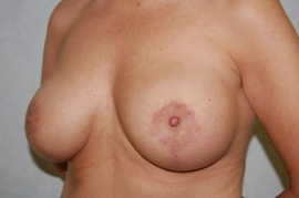 Breast Augmentation Patient 44021 After Photo # 6