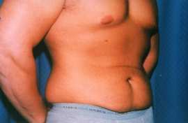 Tummy Tuck - Men Patient 43311 Before Photo # 1