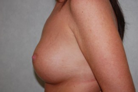 Breast Augmentation Patient 34919 After Photo # 6