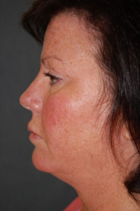 Face Lift and Neck Lift Patient 15871 Before Photo # 3