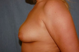 Breast Augmentation and Lift Patient 61187 Before Photo # 5