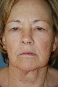 Face Lift and Neck Lift Patient 49297 Before Photo # 1
