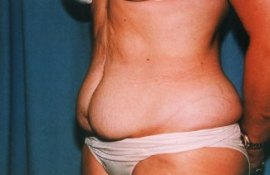 Tummy Tuck Patient 15918 Before Photo # 3