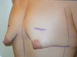 Breast Augmentation and Lift Patient 31680 Before Photo # 1