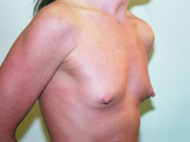 Breast Augmentation Patient 43878 Before Photo # 5