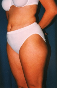 Liposuction Patient 71514 Before Photo # 3