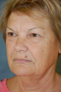 Face Lift and Neck Lift Patient 74597 Before Photo # 3