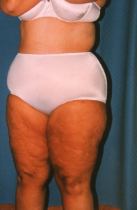 Liposuction Patient 25577 After Photo # 4