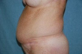 Body Lift Patient 42627 Before Photo # 5