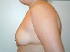 Breast Augmentation and Lift Patient 31205 Before Photo # 1