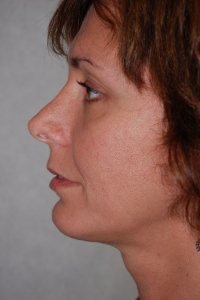 Chin Augmentation Patient 83833 After Photo # 4