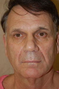 Facial Surgery - (Men) Patient 20588 Before Photo # 1