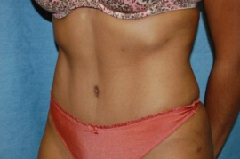 Tummy Tuck Patient 55304 After Photo # 4