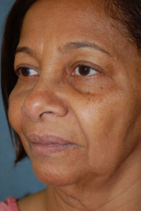 Face Lift and Neck Lift Patient 43313 Before Photo # 3