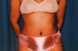 Tummy Tuck Patient 26227 After Photo # 2