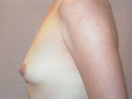 Breast Augmentation Patient 23082 Before Photo # 3