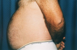 Tummy Tuck - Men Patient 44902 Before Photo # 5