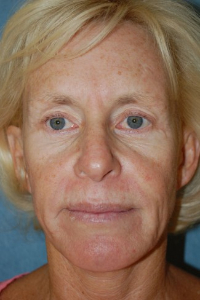 Face Lift and Neck Lift Patient 59380 Before Photo # 1