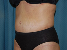 Body Lift Patient 56396 After Photo # 2