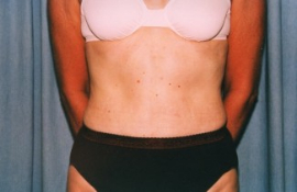 Tummy Tuck Patient 65833 After Photo # 2