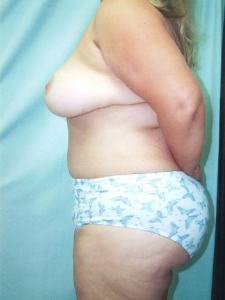Breast Enhancement and Tummy Tuck Patient 97467 After Photo # 4