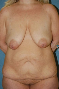 Body Lift Patient 94267 Before Photo # 1