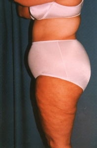 Liposuction Patient 25577 After Photo # 6