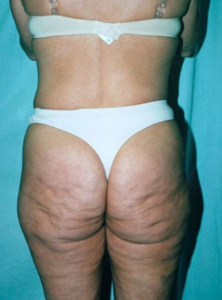 Body Lift Patient 34135 Before Photo # 1