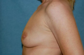 Breast Augmentation Patient 89092 Before Photo # 5