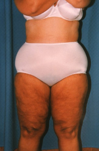 Liposuction Patient 25577 After Photo # 2