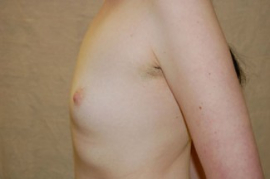 Breast Augmentation Patient 92231 Before Photo # 3