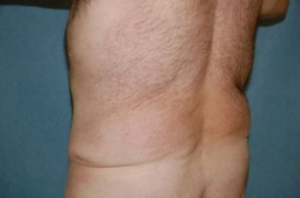 Body Lift Patient 45266 Before Photo # 3