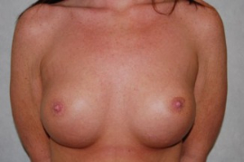 Breast Augmentation Patient 34919 After Photo # 2