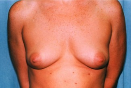 Breast Augmentation Patient 14400 Before Photo # 1